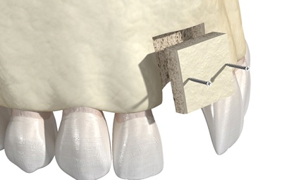 Illustration of block bone graft to prepare mouth for dental implants